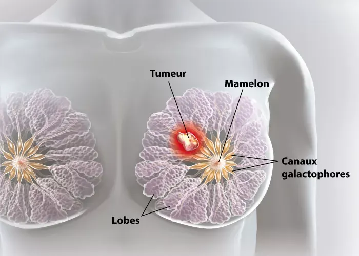 Chirurgie Gynécologique