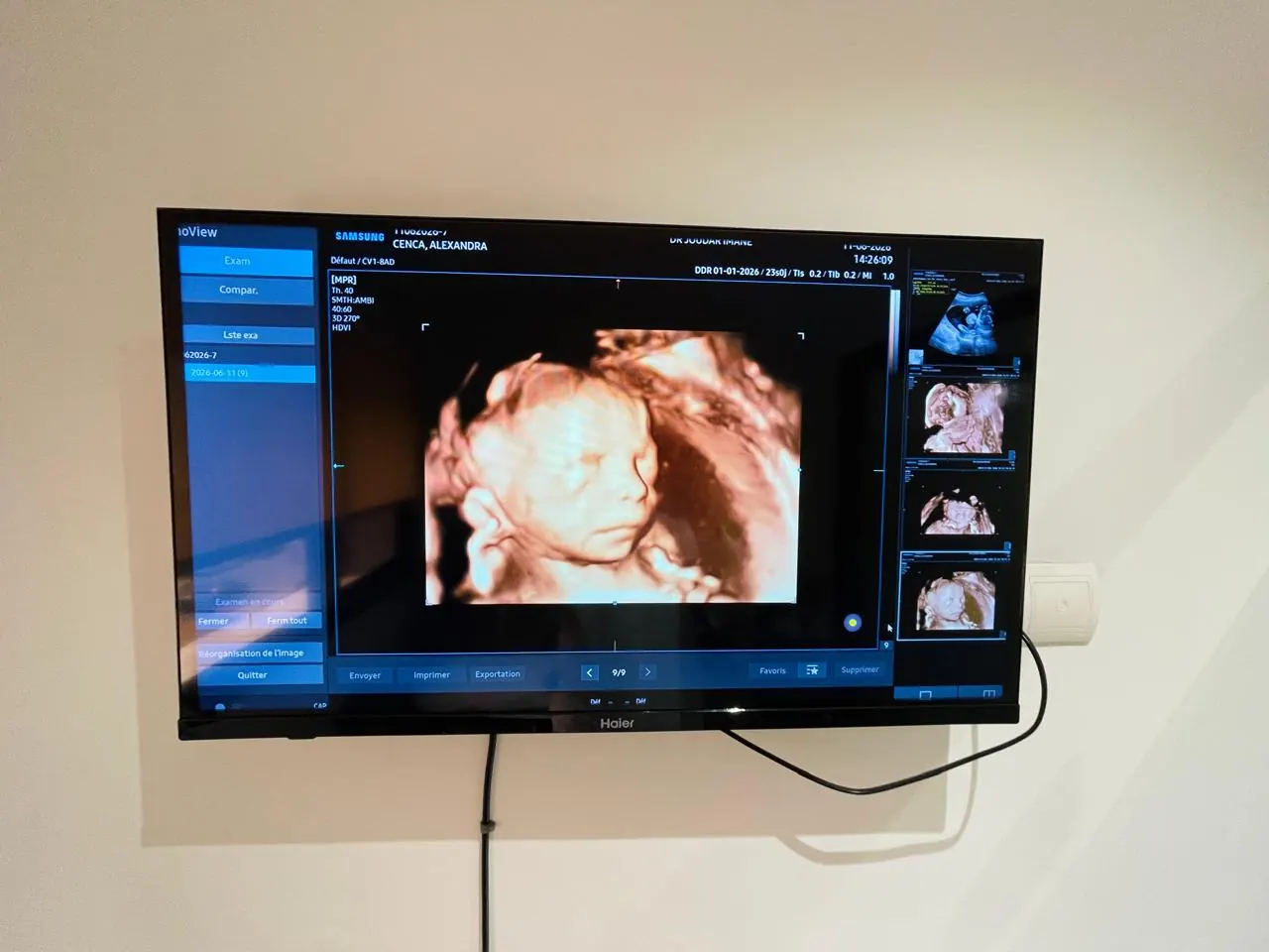 Échographie 3D/4D de bébé au cabinet du gynécologue à Mohammedia